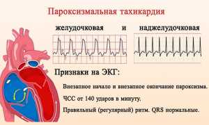 Особенности течения пароксизмальной наджелудочковой тахикардии