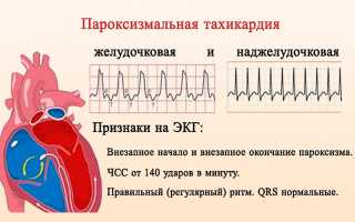 Особенности течения пароксизмальной наджелудочковой тахикардии