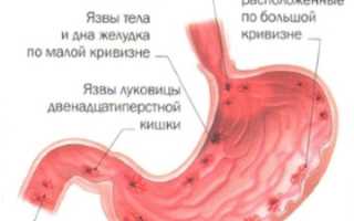 Что такое Язва желудка
