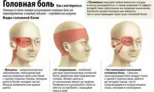 Мигрень — патология приступов головной боли