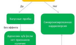 Первая помощь и диагностика при пароксизмальной тахикардии