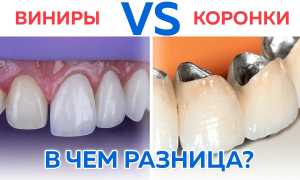 Виды зубных коронок и что такое «виниры»