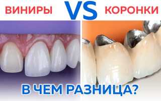 Виды зубных коронок и что такое «виниры»