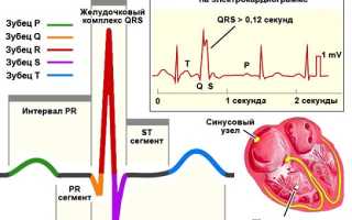 Чем опасна экстрасистолическая аритмия