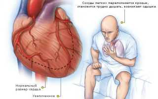 Как жить с кардиомиопатией