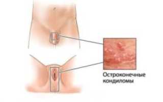 Папилломы на интимных местах у женщин и мужчин: симптомы, опасность, удаление в зоне бикини