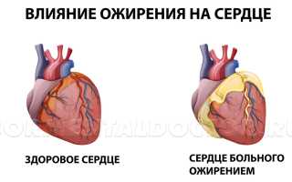 Как влияет ожирение на сердце, и каким образом худеть сердечникам
