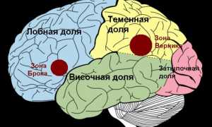 Нарушения речи после перенесённого инсульта: виды и лечение